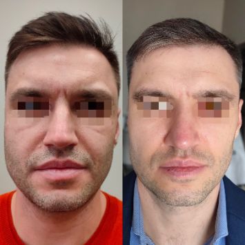 Септопластика