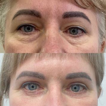 Блефаропластика