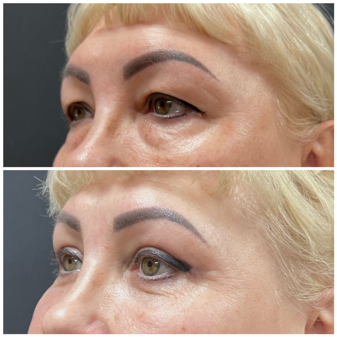 Круговая блефаропластика