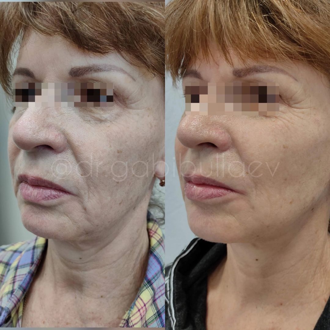 Подтяжка лица и шеи