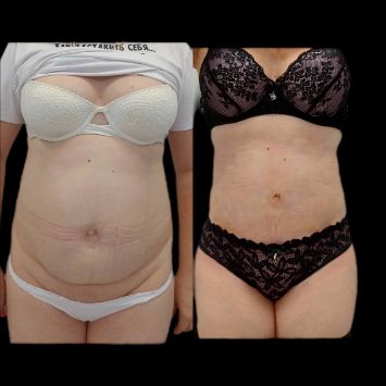 Абдоминопластика с липосакцией