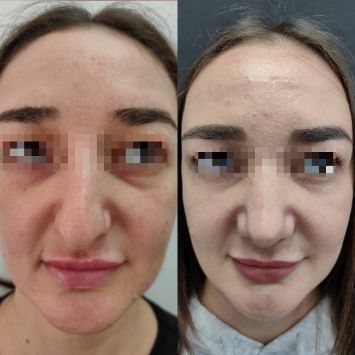 Ринопластика