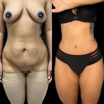 Липосакция живота