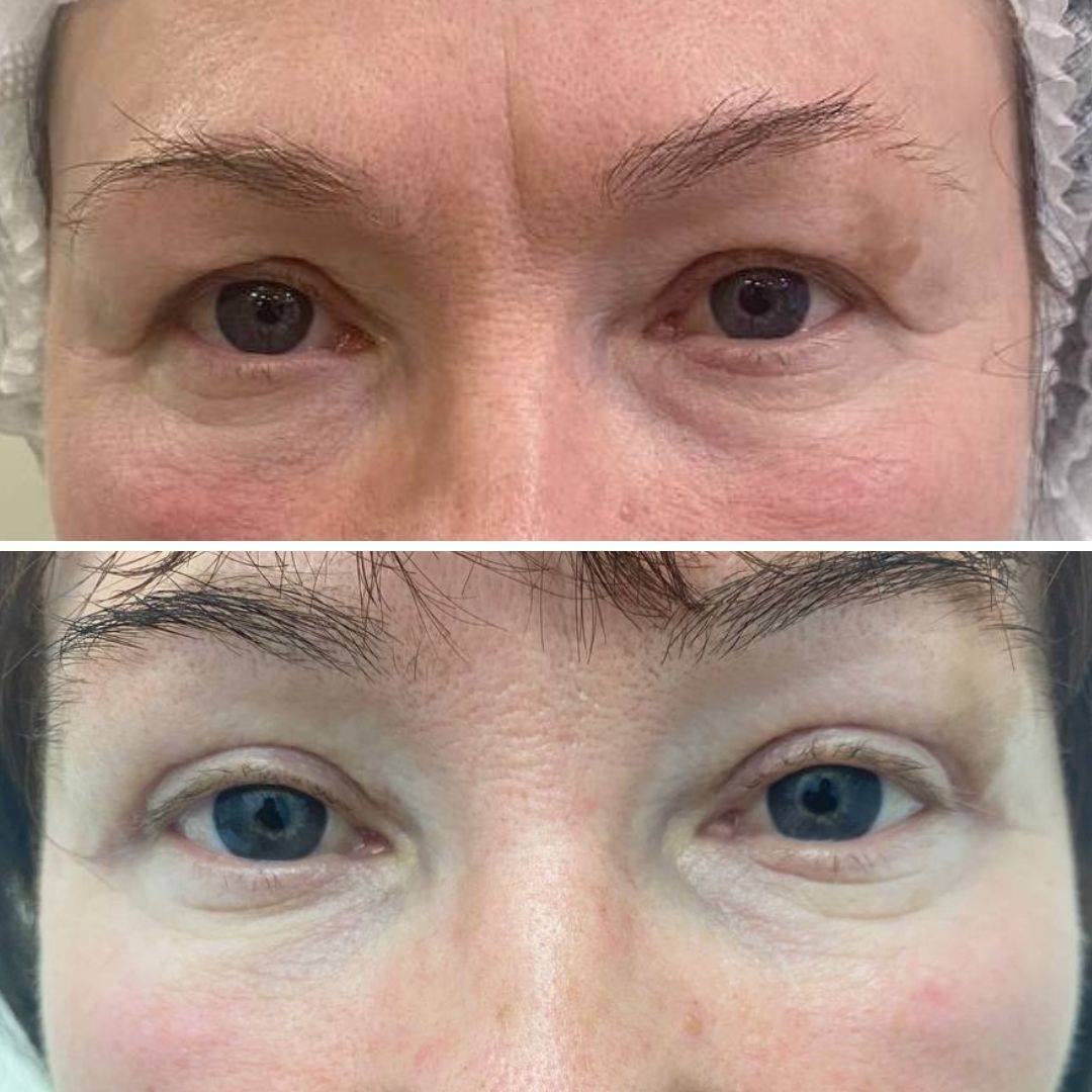 Верхняя блефаропластика Краснодар