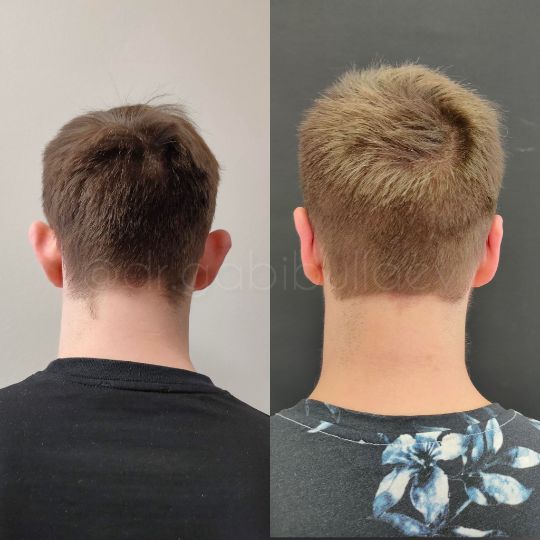 Отопластика