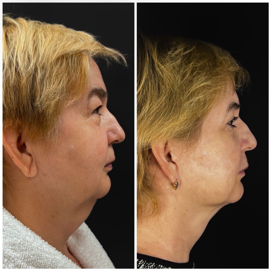 Фейслифтинг