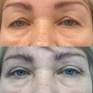 Верхняя блефаропластика