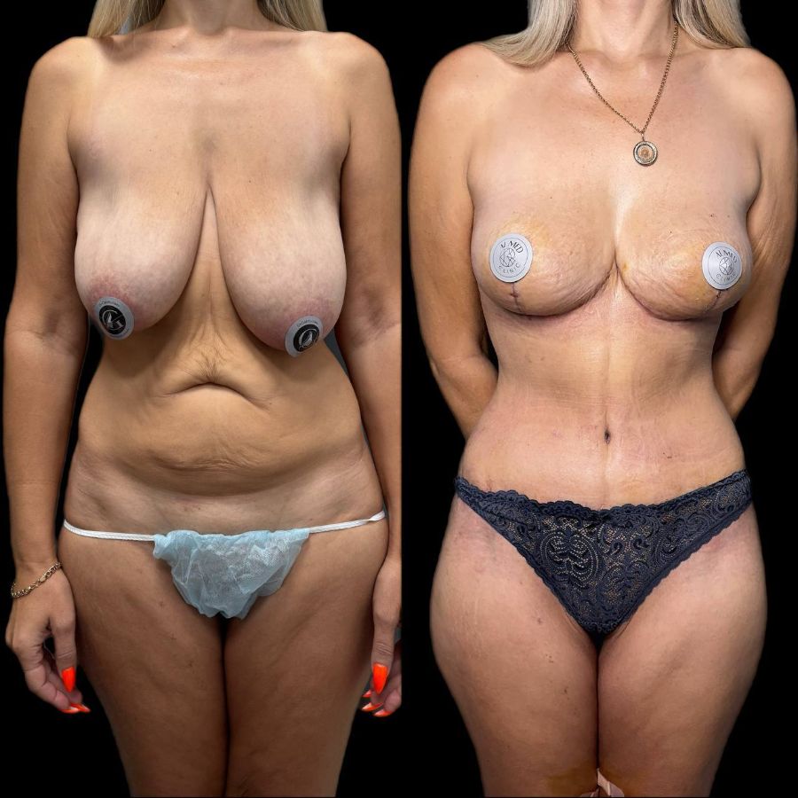 Подтяжка кожи после похудения