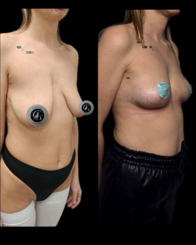 Подтяжка груди без имплантов