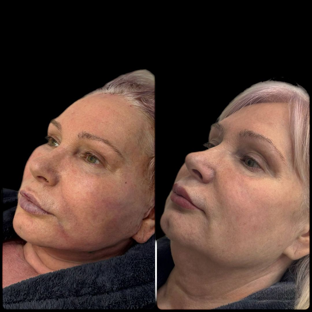 Подтяжка лица