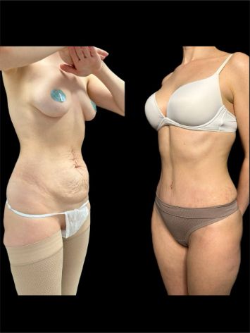 Абдоминопластика