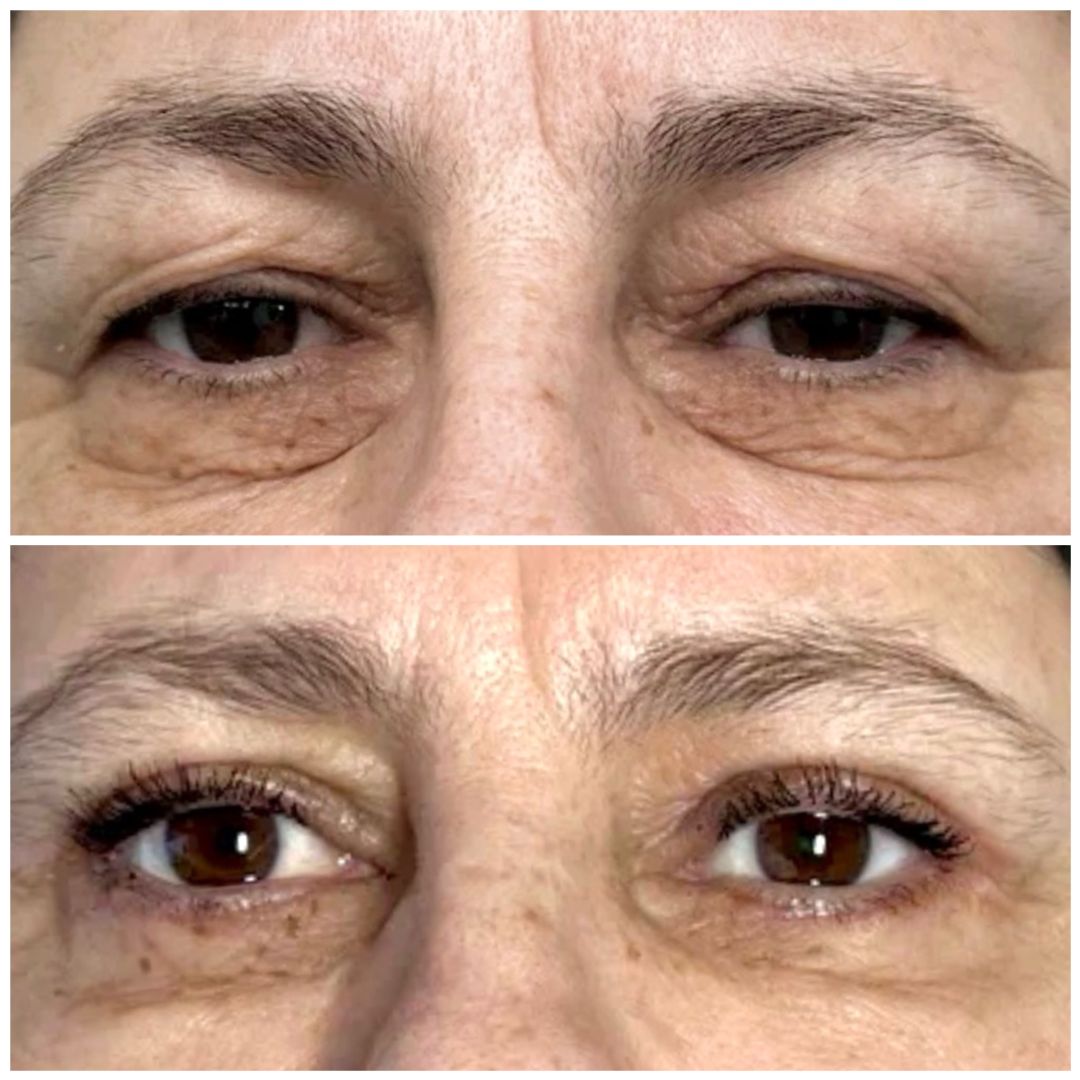 Круговая блефаропластика