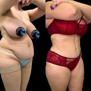Пластика живота Краснодар
