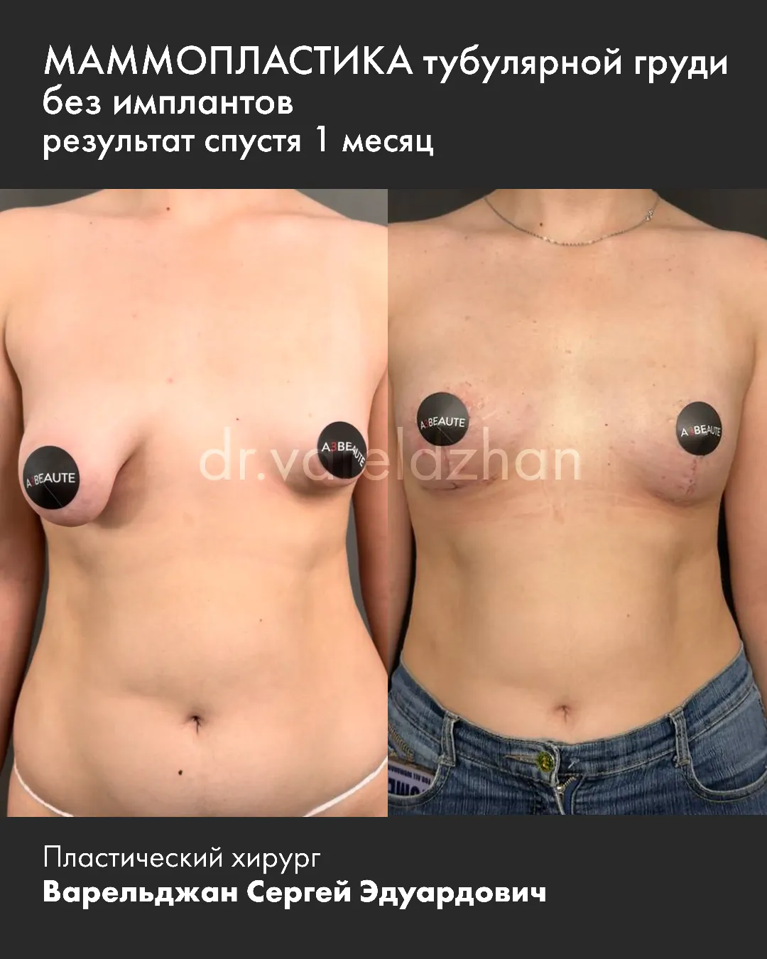 Пример работы доктора Варельджана Сергея Эдуардовича в области маммопластики.