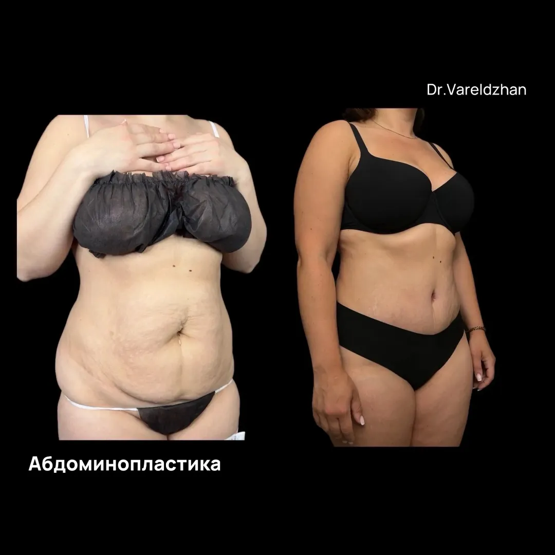 Пример работы доктора Варельджана Сергея Эдуардовича в области абдоминопластики.