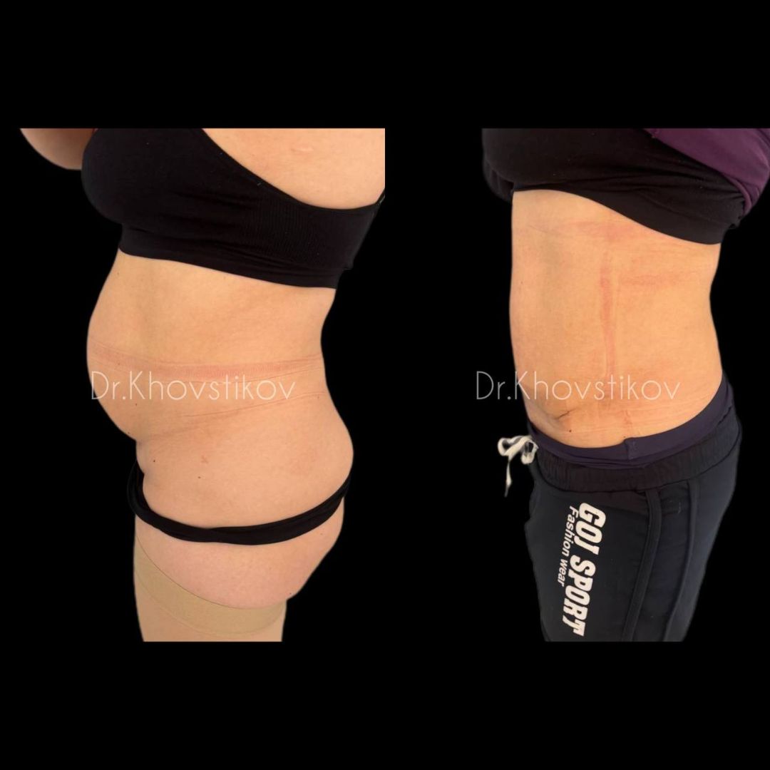 Ушивание диастаза пластика живота