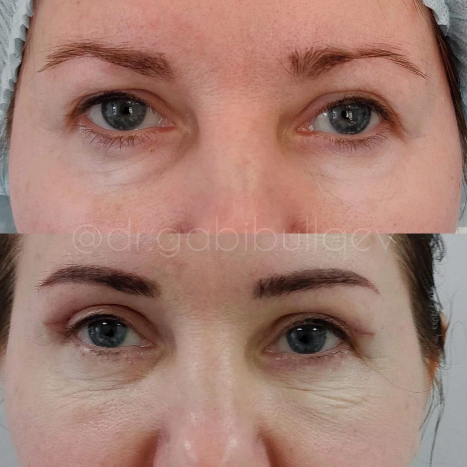 Верхняя блефаропластика Краснодар