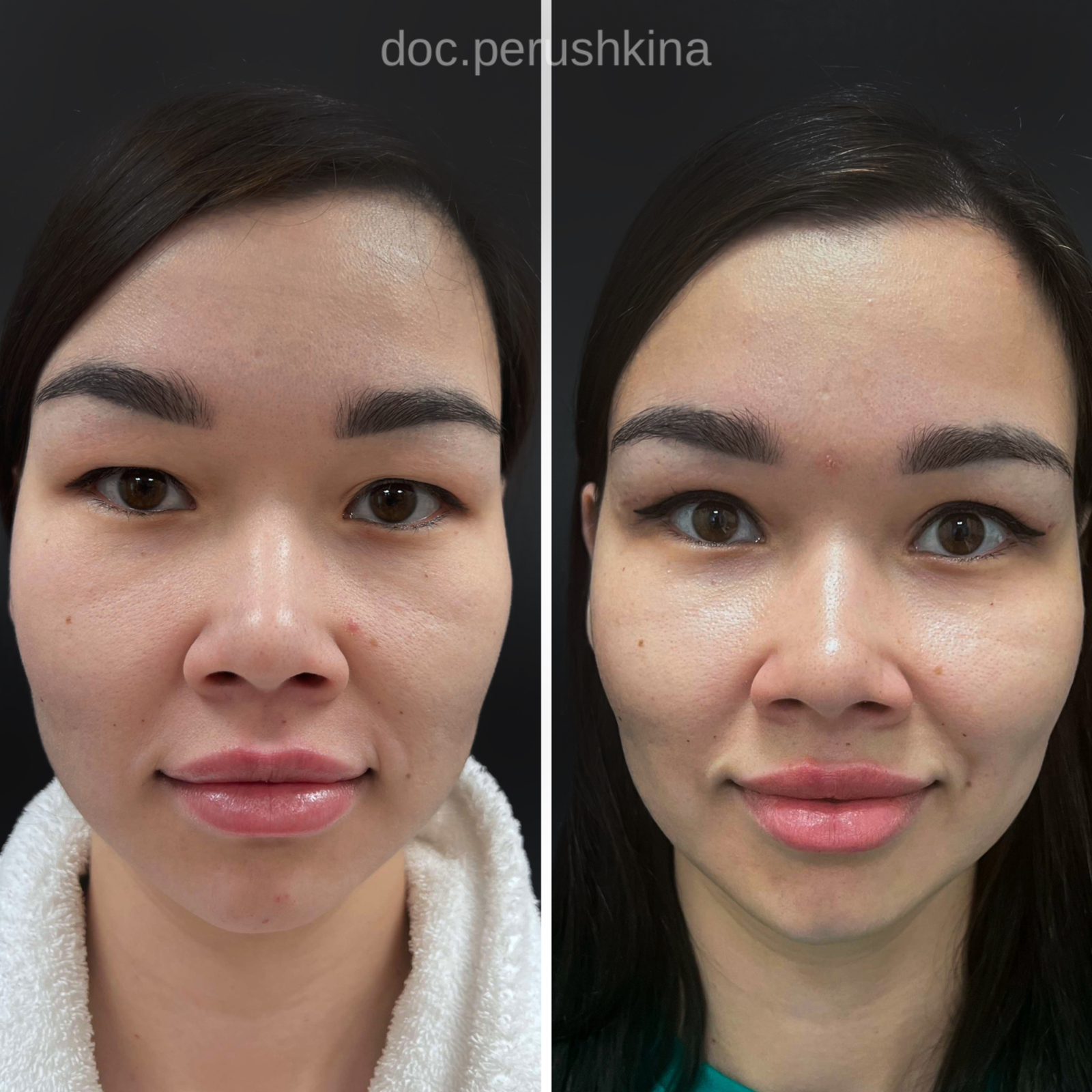 Блефаропластика