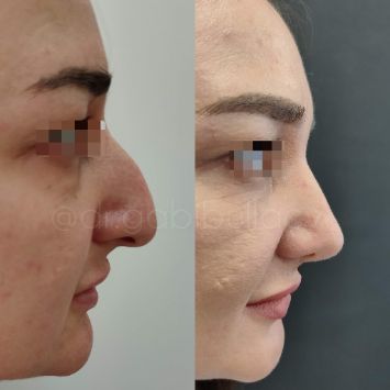 Риносептопластика Краснодар