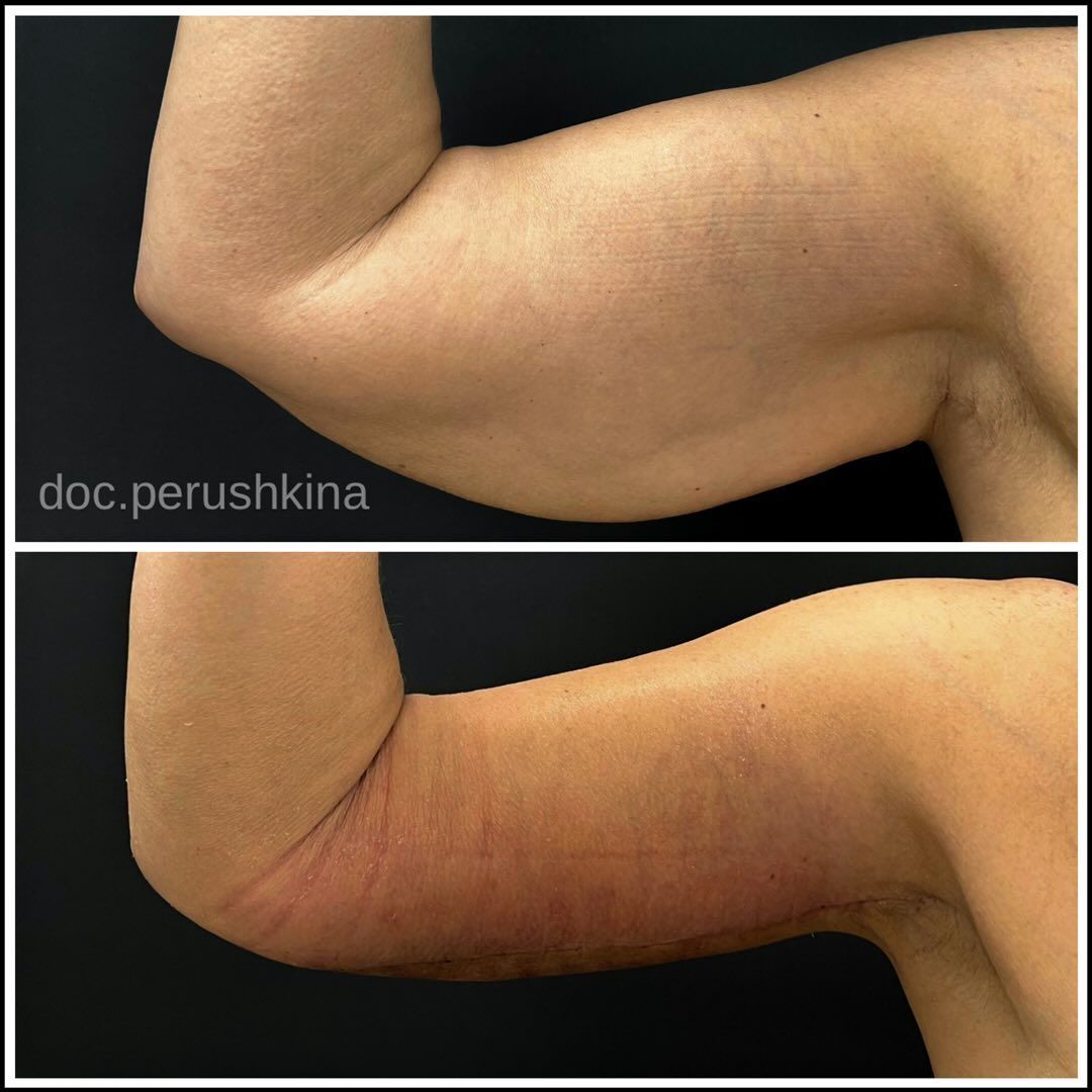 Брахиопластика