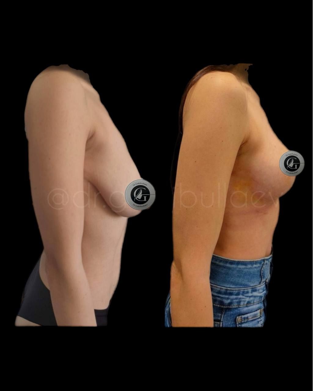 Т-образная подтяжка