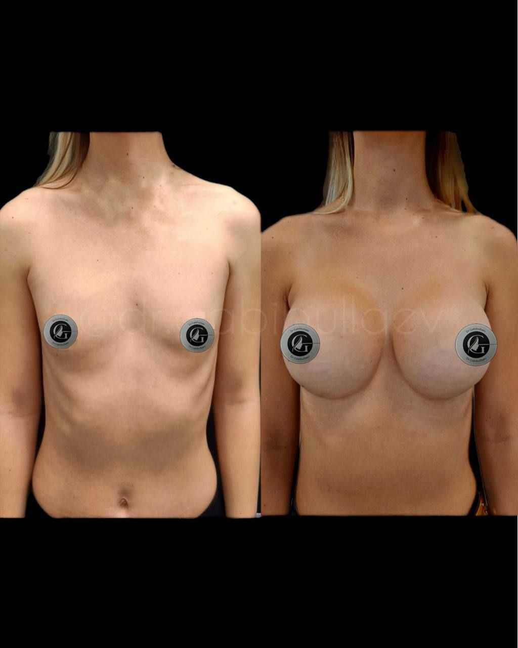 Увеличение груди