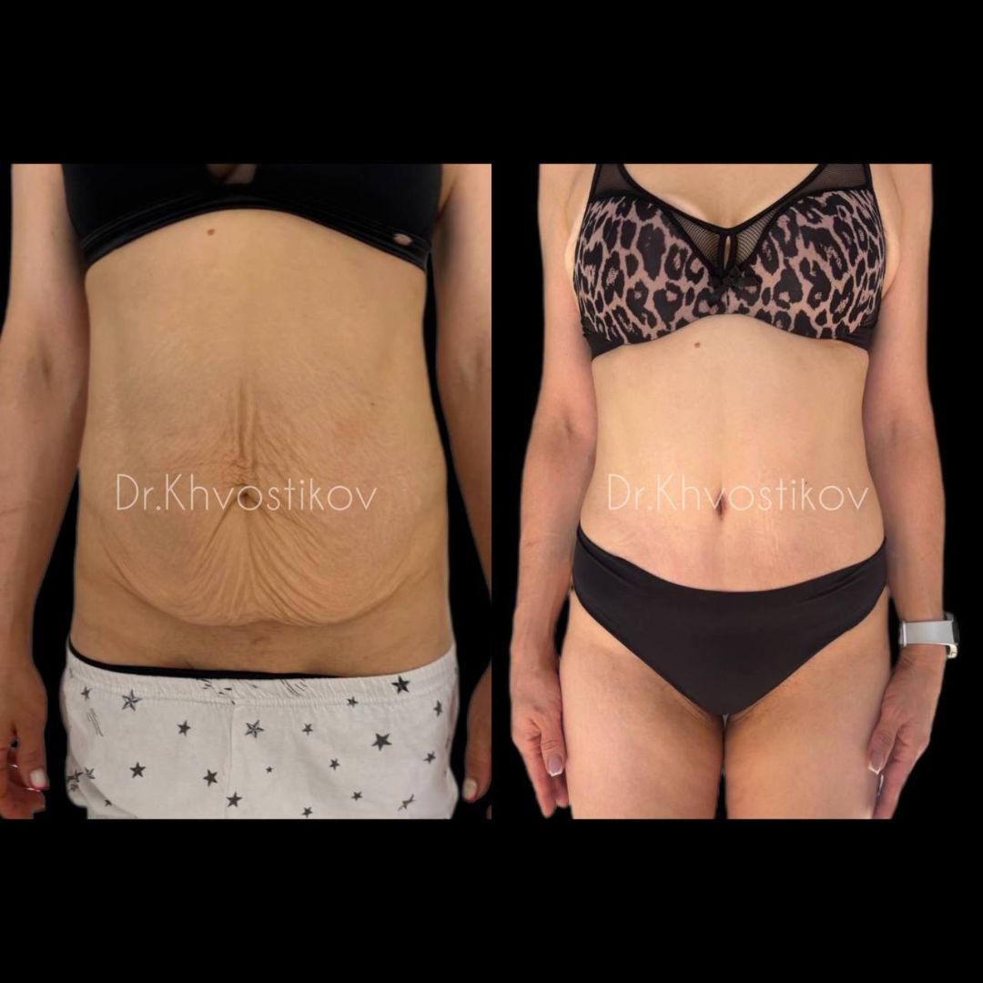 Абдоминопластика