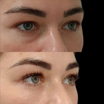 Нижняя трансконъюнктивальная блефаропластика