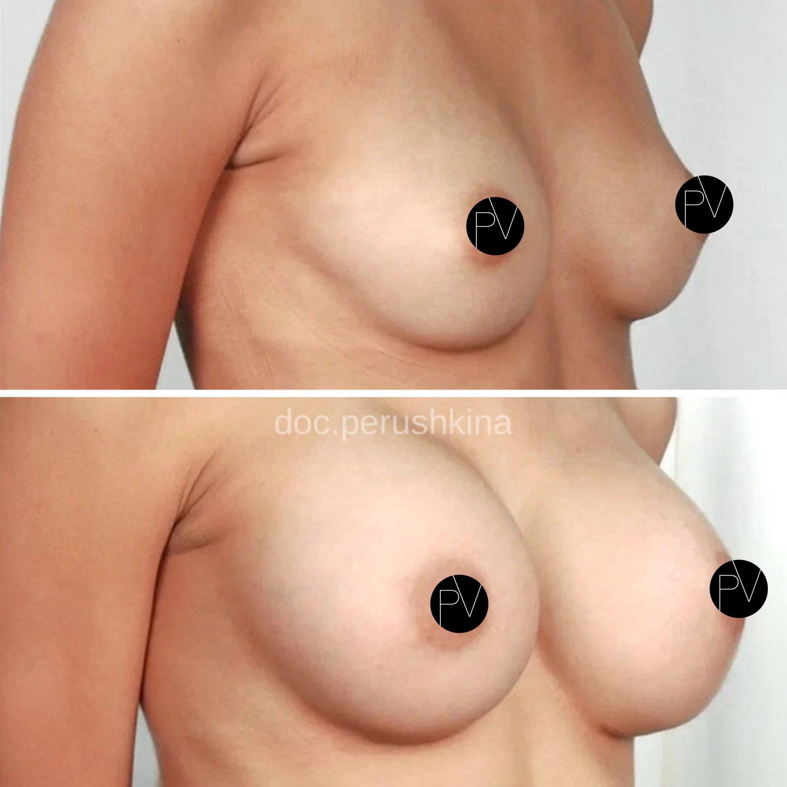 Увеличение груди