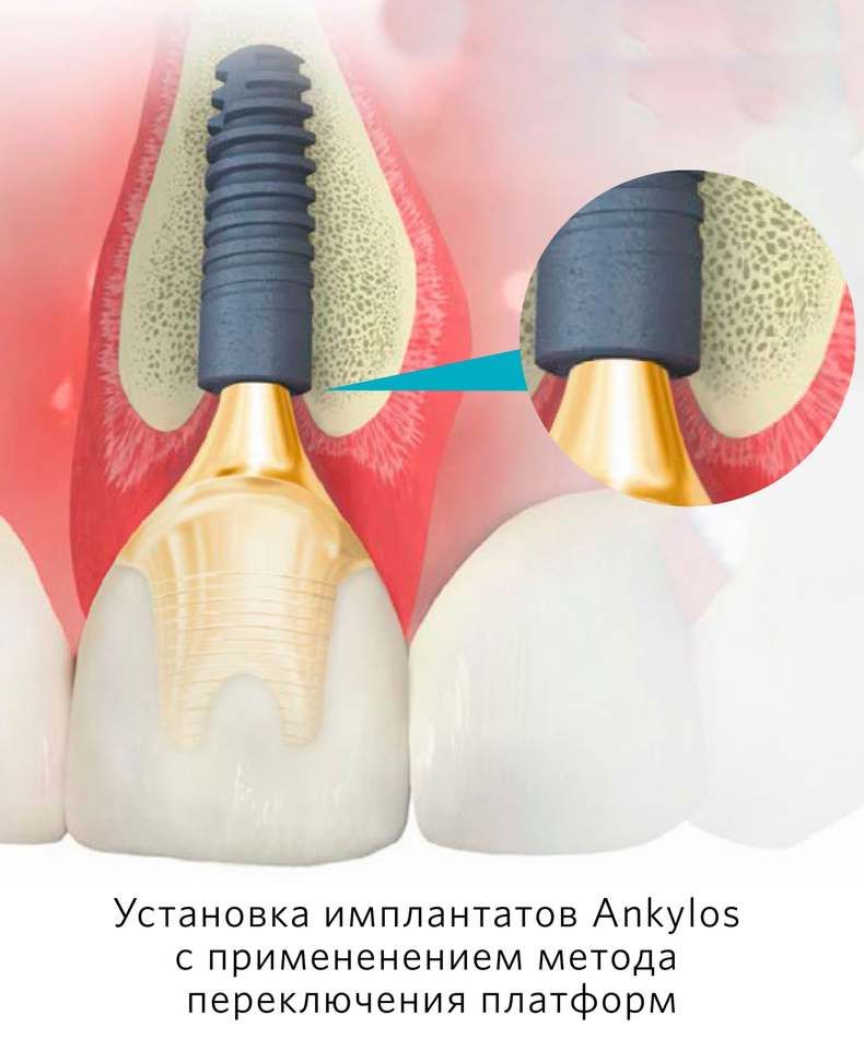 PHARMGEOCOM - ANKYLOS