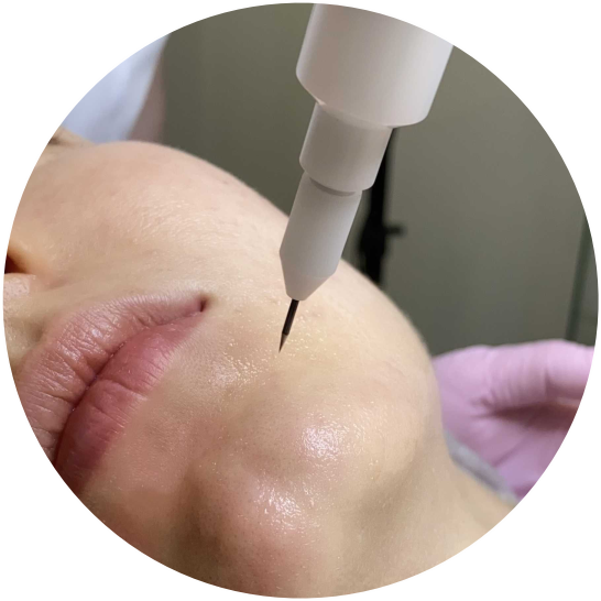 холодная плазма Екатеринбург