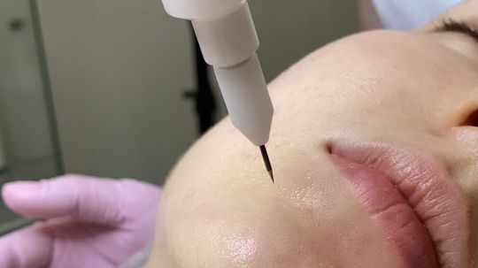 холодная плазма Екатеринбург