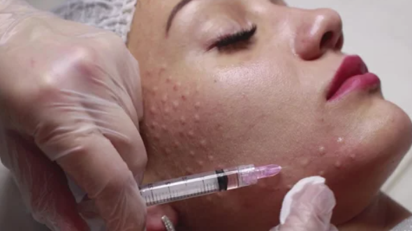 Биоревитализация Екатеринбург