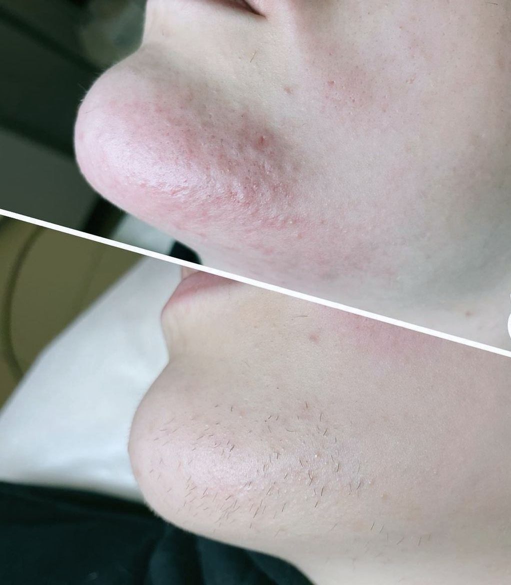 Подбородок 20-40мин