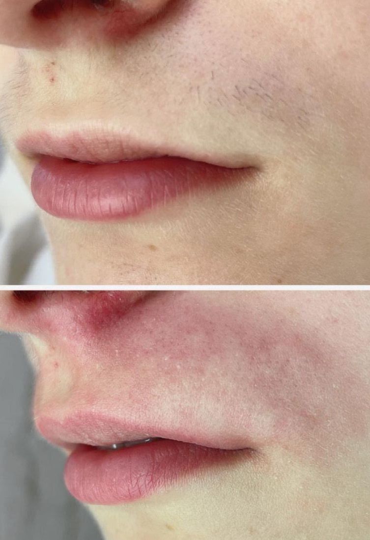 Над верхней губой 15-30мин