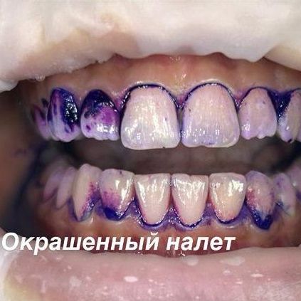 Профессиональная чистка зубов - окрашенный налет