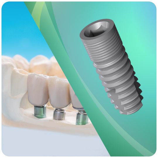 Установка импланта Niko (Rusimplant) в клинике дентальной имплантации Апекс-Д по акции 20 000 руб