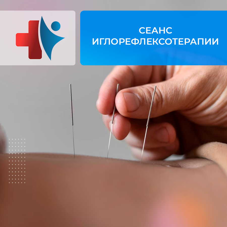 Иглоукалывание