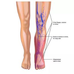 Воспалённая вена с покраснением, отёком и локальным повышением температуры кожи.
