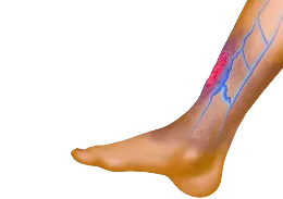 Крупный план ноги с открытой язвой на фоне варикозного расширения вен.