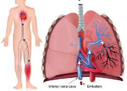 Иллюстрация сосудов с закупоркой лёгочной артерии, указывающей на опасность ТЭЛА.