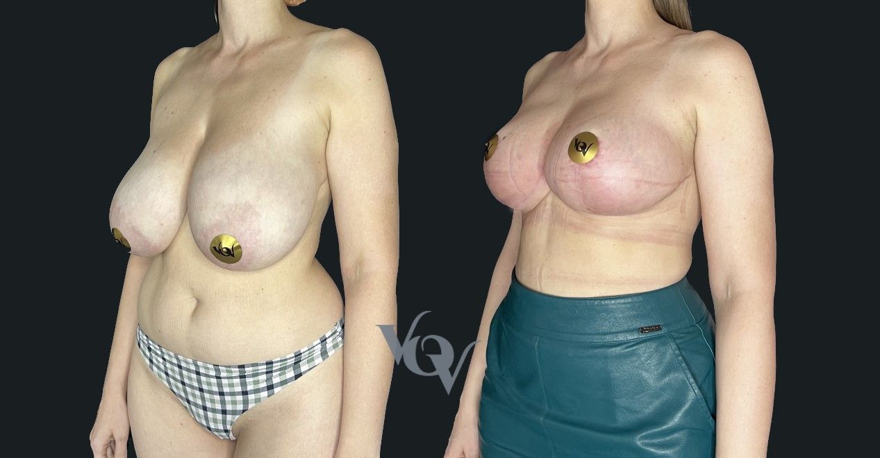 Уменьшение груди. 2,5 месяца после операции 