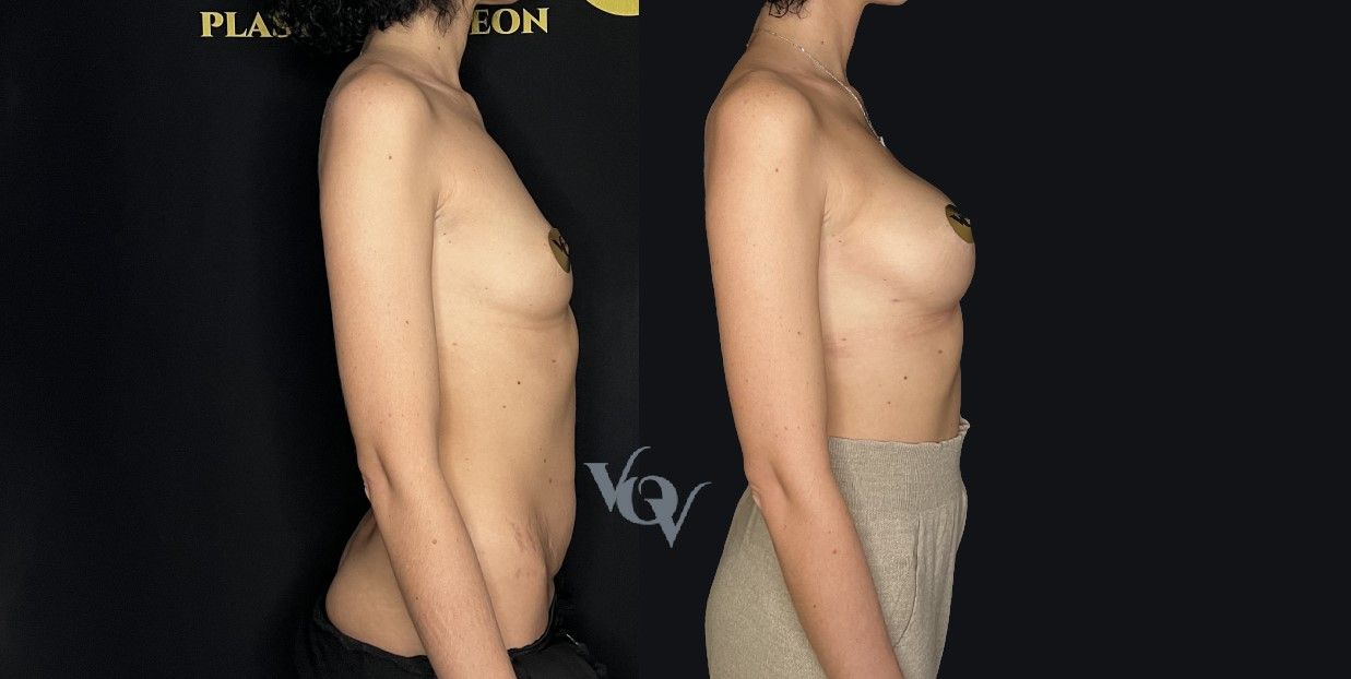 Замена имплантов. 1 месяц после операции