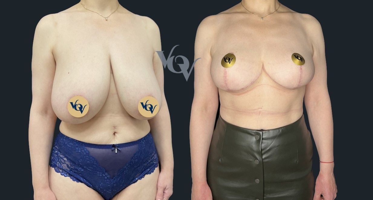 Уменьшение груди. 2 месяца после операции 