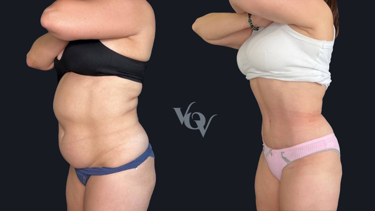 Абдоминопластика. 1 месяц после операции