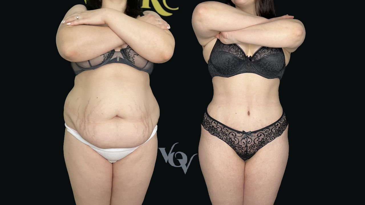 Абдоминопластика. 3 месяца после операции