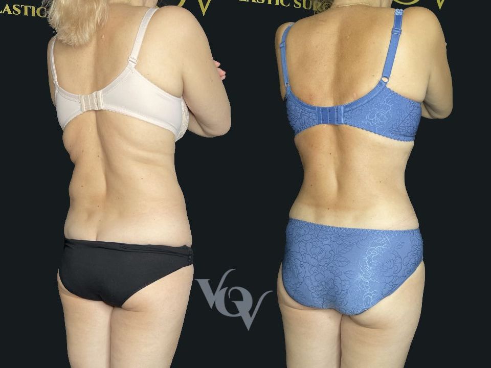 Липосакция спины. 4 месяца после операции