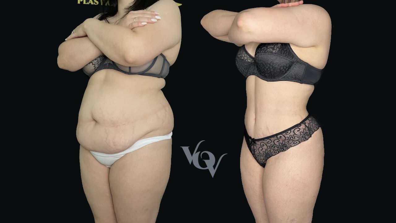 Абдоминопластика. 3 месяца после операции