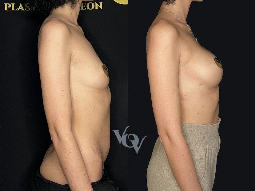 Увеличение груди. 2 месяца после операции