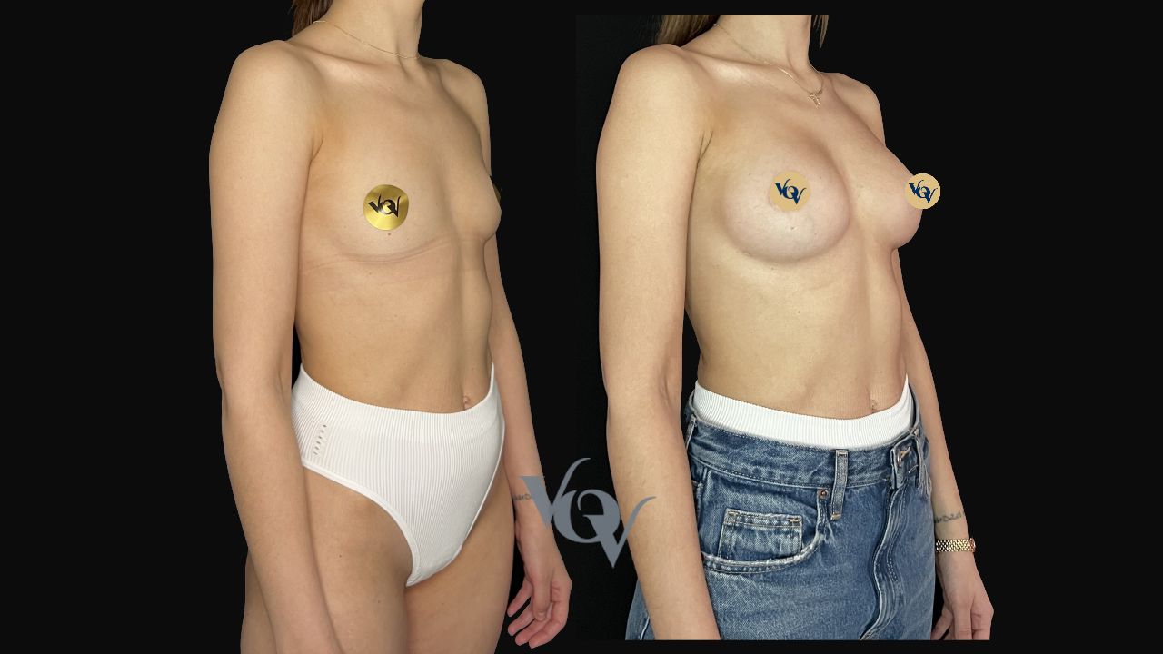 Замена имплантов. 1 год после операции